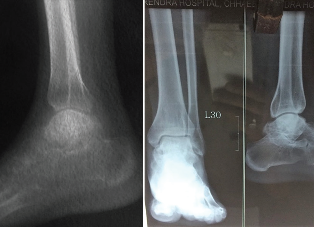 talus bone x ray