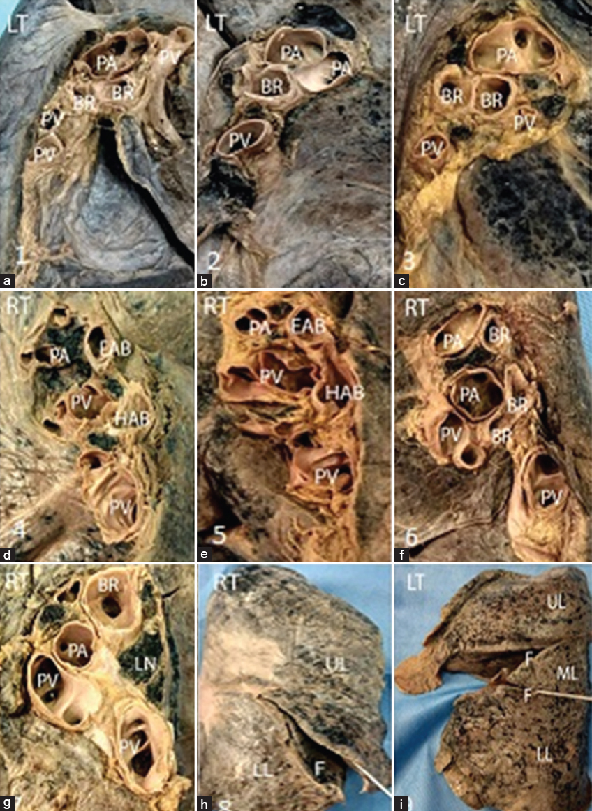 Cadaveric Study of Lung Anatomy: A Surgical Overview | Journal of