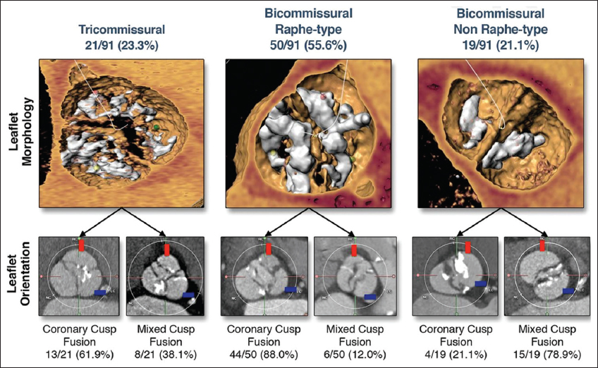 bicuspid aortic valve types